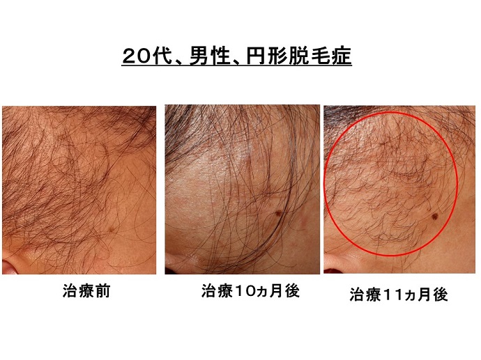 円形脱毛症　病院